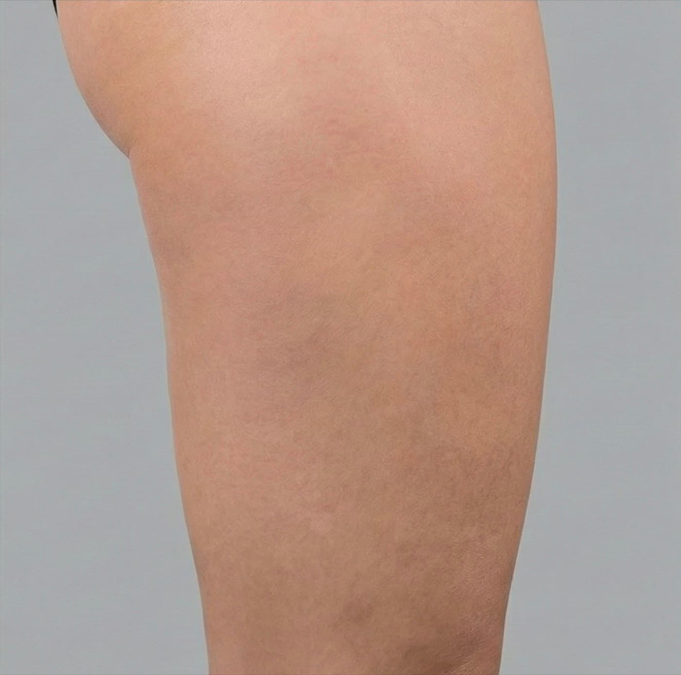 Dopo Ossigeno-ozonoterapia