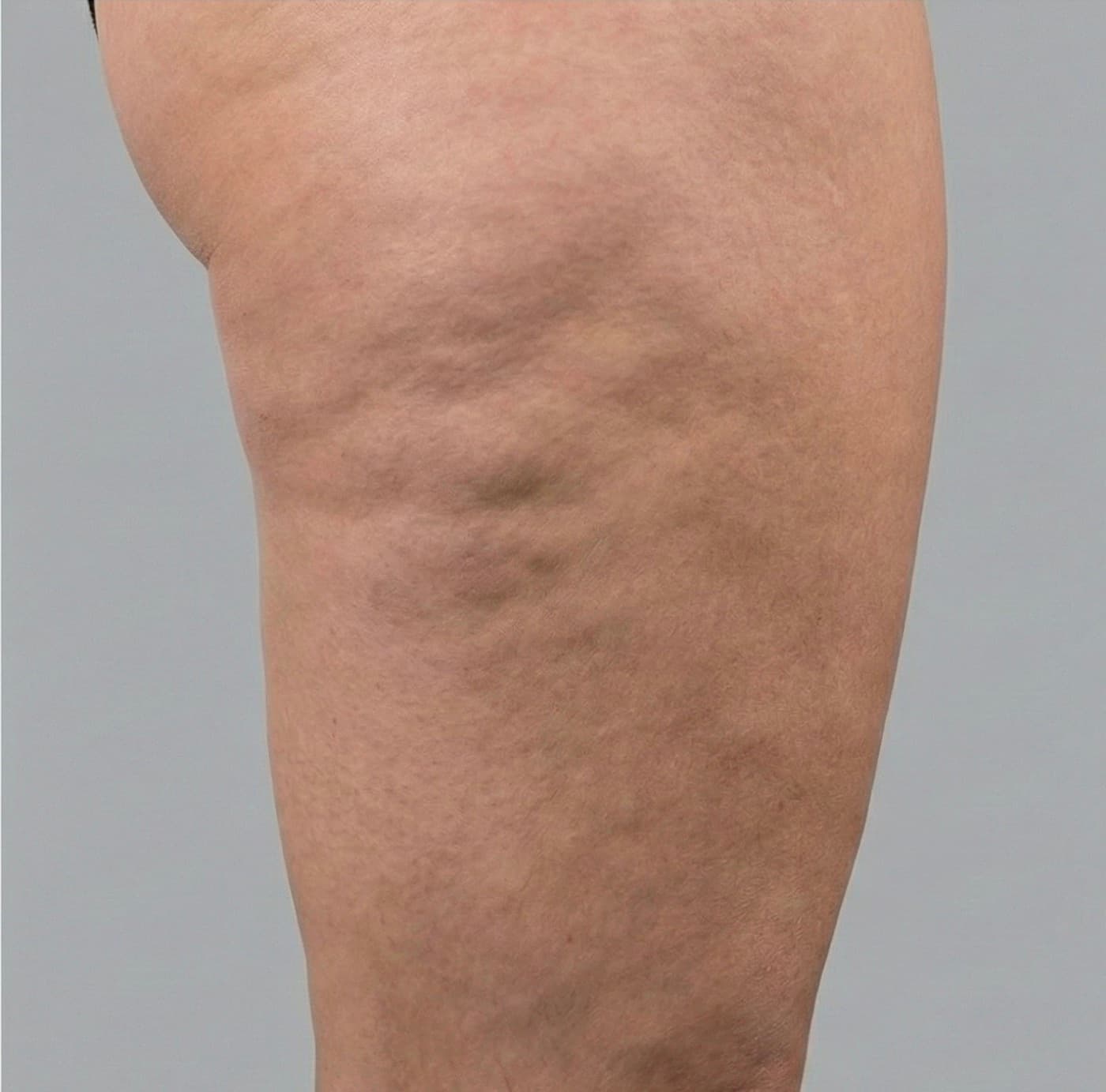 Prima Ossigeno-ozonoterapia